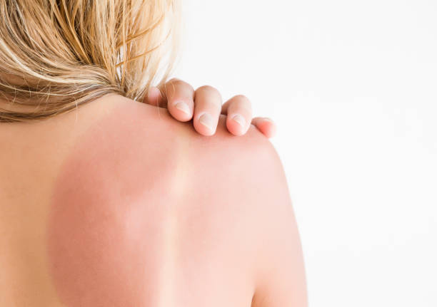 istock Woman's back skin hurt from sun burn. 691747920