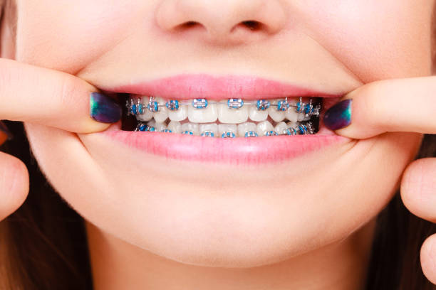 mujer mostrando los dientes con brackets - banda correctora fotografías e imágenes de stock
