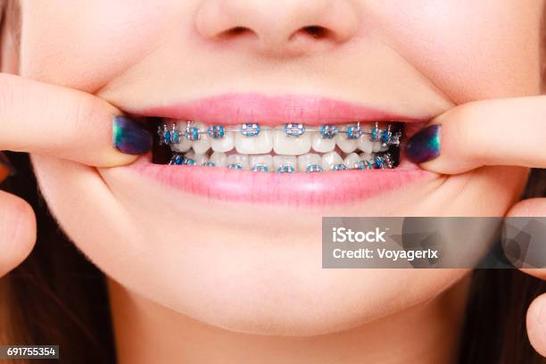Dişlerini Diş Telleri Ile Gösterilen Kadın Stok Fotoğraflar & Diş Telleri‘nin Daha Fazla Resimleri - Diş Telleri, Ortodontist, Gülümseme