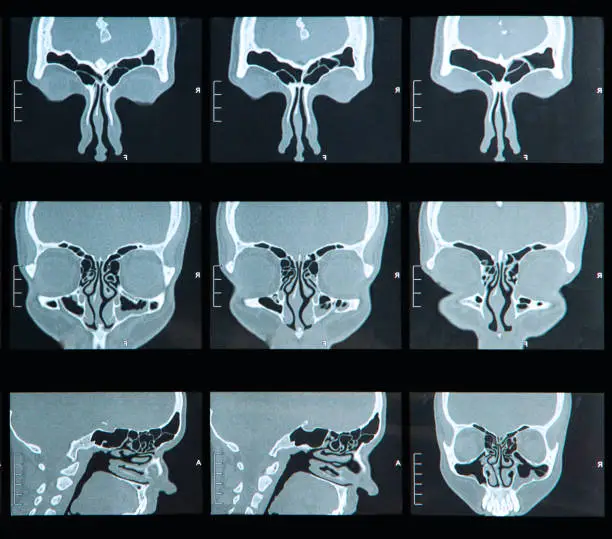 MRI scan of the human sinus  with Nasal Passages