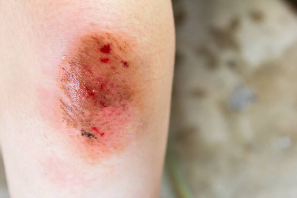 ferita da ferita contusa sullo sfondo del ginocchio della donna - insurance healthcare and medicine industry damaged foto e immagini stock