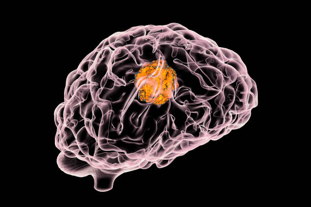 Brain tumor, illustration Brain cancer, 3D illustration showing presence of tumor inside brain brain tumour stock pictures, royalty-free photos & images