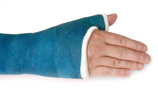 istock Broken Wrist, Arm with a Blue Fiberglass Cast on a white background 692801448