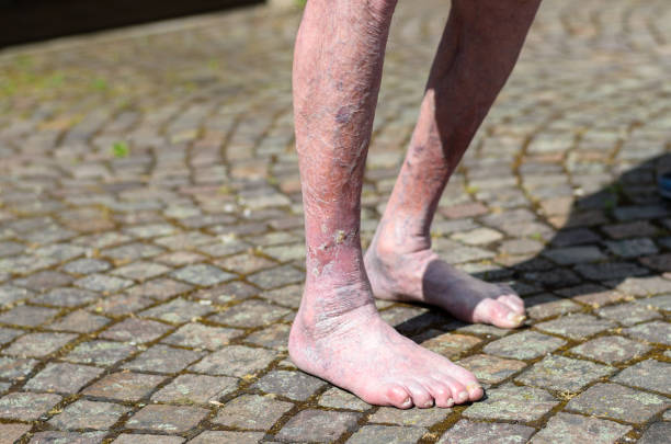 istock Leg of an old person with circulatory problems 692811636