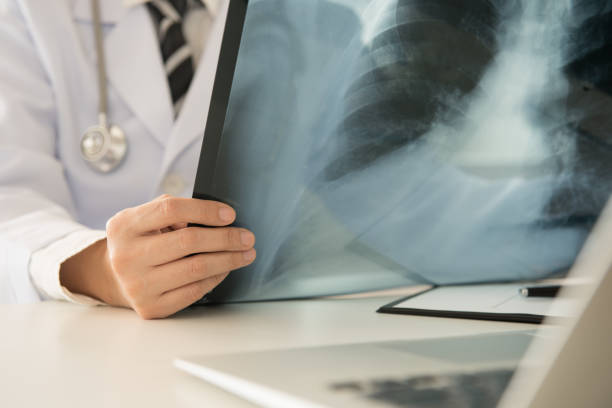 radiologist doctor Radiologist doctor examining at lungs radiograph x-ray film of patient in roentgen room. cancer screening stock pictures, royalty-free photos & images
