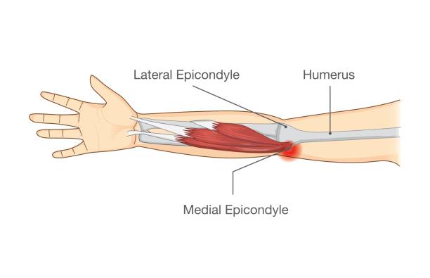 ilustrações de stock, clip art, desenhos animados e ícones de muscle injury and tear in tendon at elbow area. - elbow