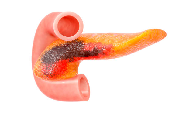 Pancreatic Cancer Concept