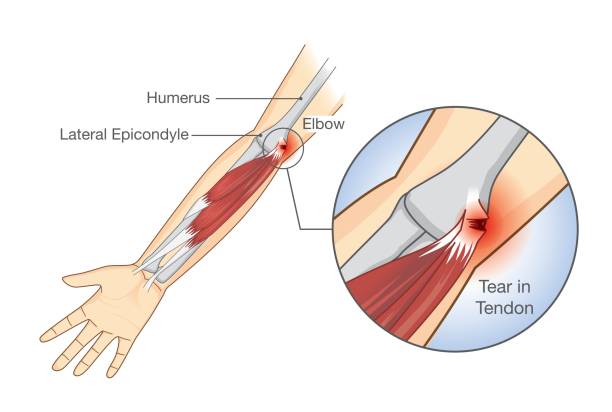 筋肉の損傷や肘エリアで腱の涙。 - anatomy human bone human muscle human hand点のイラスト素材／クリップアート素材／マンガ素材／アイコン素材