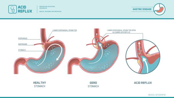Acid reflux and heartburn infographic Acid reflux, heartburn and gerd infographic with medical illustration: stomach acid moving up into the esophagus causing acid reflux symptoms sphincter stock illustrations