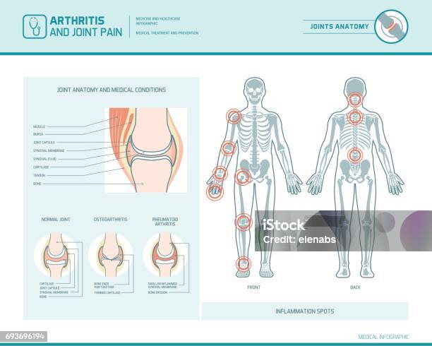 Ilustración de Infografía De Dolor De Artritis Y Articulaciones y más Vectores Libres de Derechos de Articulación - Articulación, Esqueleto humano, Artritis reumatoide