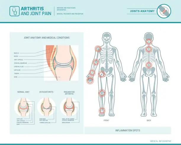 Vector illustration of Arthritis and joint pain infographic