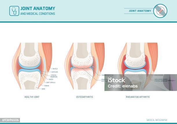 Mixte Infographique De Lanatomie Larthrose Et La Polyarthrite Rhumatoïde Vecteurs libres de droits et plus d'images vectorielles de Articulations