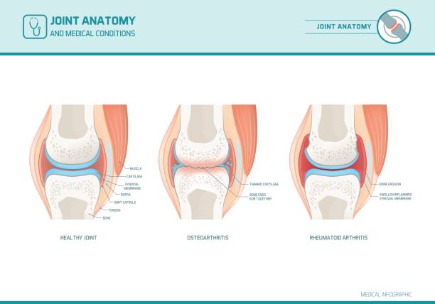 illustrazioni stock, clip art, cartoni animati e icone di tendenza di infografica anatomia articolare, osteoartrite e artrite reumatoide - artrite