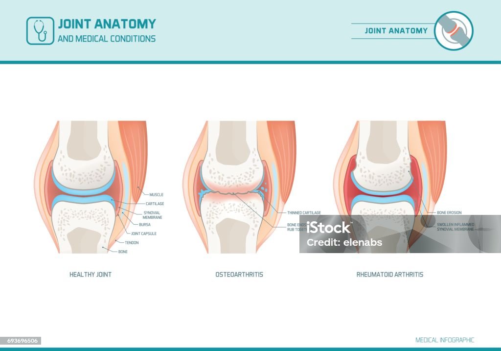 Joint anatomy, osteoarthritis and rheumatoid arthritis infographic Joint anatomy, osteoarthritis and rheumatoid arthritis infographic with anatomical illustrations Joint - Body Part stock vector