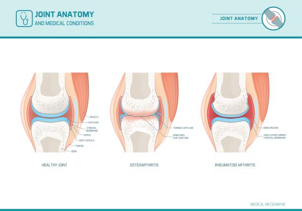 Joint anatomy, osteoarthritis and rheumatoid arthritis infographic Joint anatomy, osteoarthritis and rheumatoid arthritis infographic with anatomical illustrations rheumatoid arthritis stock illustrations