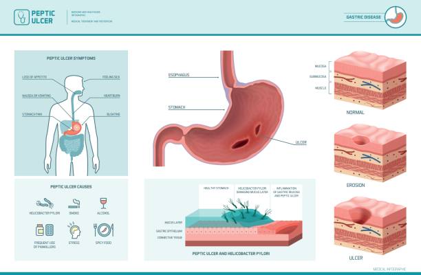 ilustraciones, imágenes clip art, dibujos animados e iconos de stock de péptica úlcera y helicobacter pylori infografía - pylori