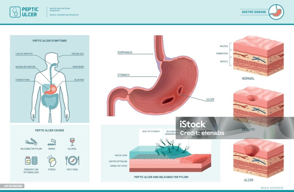 Peptic ulcer and helicobacter pylori infographic Peptic ulcer and helicobacter pylori infographic with symptoms and causes, stomach cross section diagram, medical illustration Gastric Ulcer stock vector