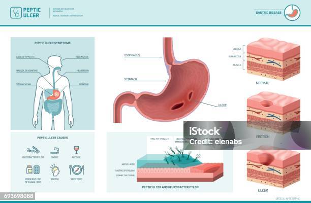 Peptic Ulcer And Helicobacter Pylori Infographic Stock Illustration - Download Image Now - Gastric Ulcer, Peptic Ulcer, Helicobacter Pylori