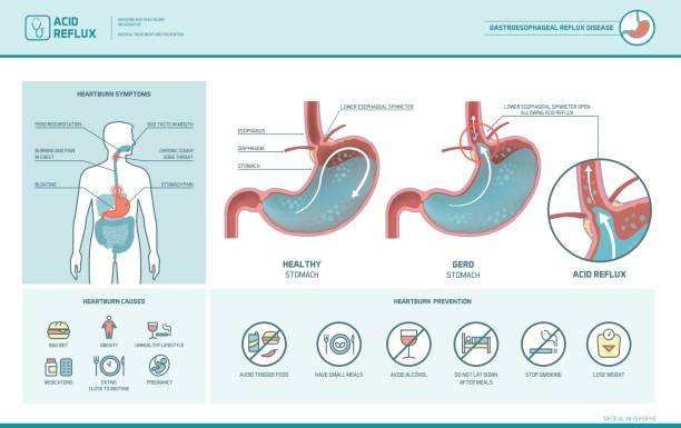Acid reflux and heartburn infographic Acid reflux, heartburn and gerd infographic with stomach medical illustration, symptoms, causes and prevention pyloric sphincter stock illustrations