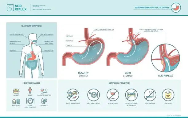 Vector illustration of Acid reflux and heartburn infographic