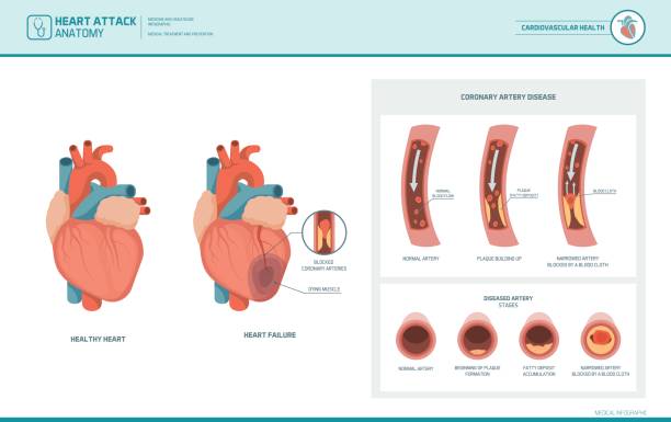 Anatomy of a heart attack Heart attack and atherosclerosis medical illustration: healthy and damaged heart, blood vessel section with fatty deposit accumulation human artery stock illustrations