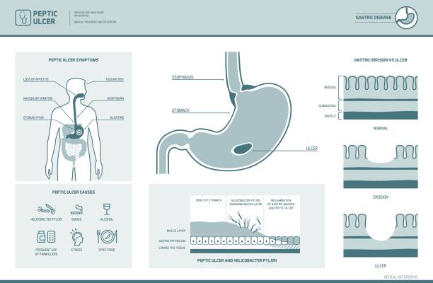 ilustraciones, imágenes clip art, dibujos animados e iconos de stock de péptica úlcera y helicobacter pylori infografía - pylori