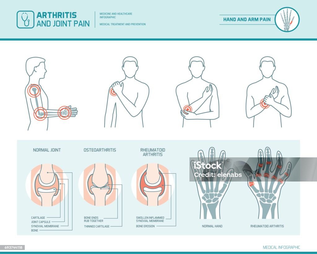 Arthritis and joint pain Arthritis and joint pain infographic, anatomic illustration of an inflammed hand and arm Rheumatoid Arthritis stock vector