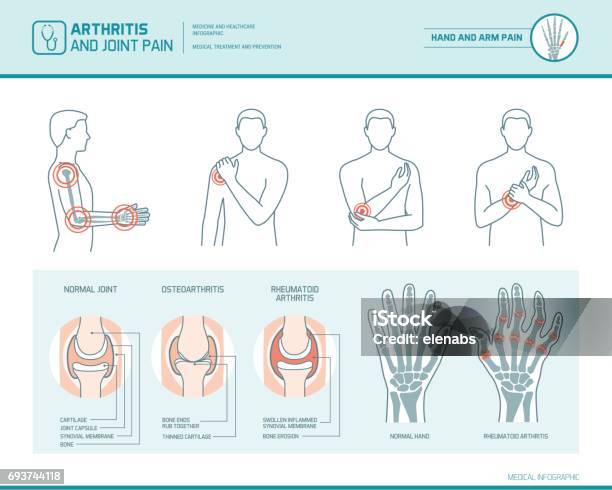 Arthritis And Joint Pain Stock Illustration - Download Image Now - Rheumatoid Arthritis, Arthritis, Pain