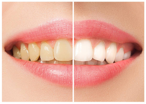 die weibliche zähne vor und nach der aufhellung - zahnaufhellung stock-fotos und bilder