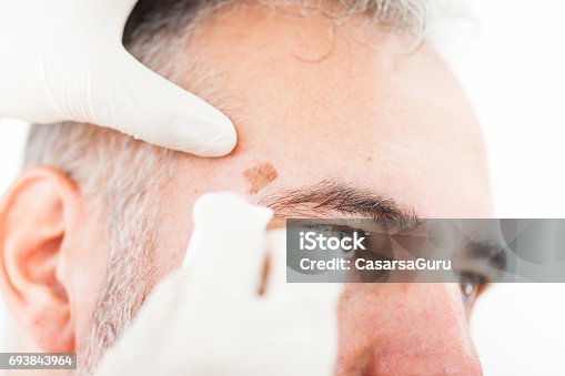 istock Chryotherapy used to Removed an Aged Spot 693843964