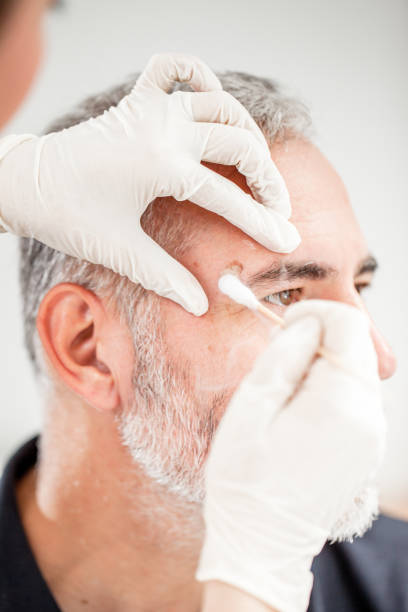 istock Chryotherapy used to Removed an Aged Spot 693844028