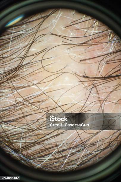 Dermoscopy Of A Scalp Stock Photo - Download Image Now - Human Hair, Human Scalp, Magnification