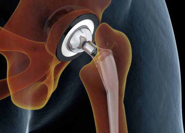 medizinisch genaue darstellung der hüftgelenkersatz. 3d illustration. - hip replacement stock-fotos und bilder