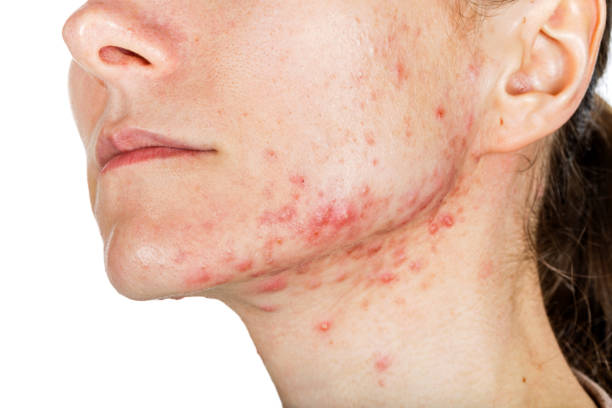 istock Young girl with skin problem 694066506