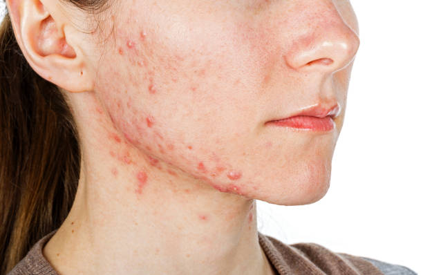 istock Young girl with skin problem 694068898
