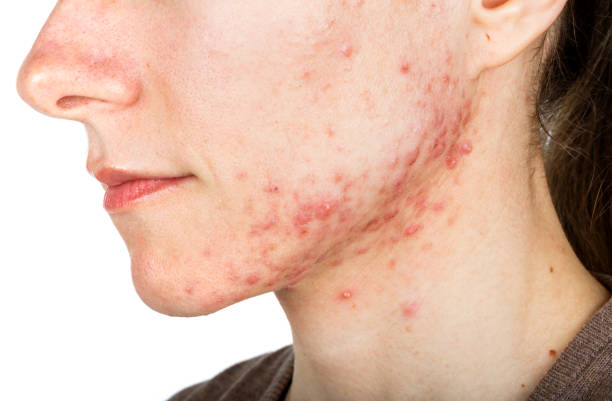 istock Young girl with skin problem 694069284