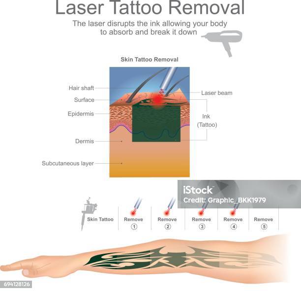 Usuwanie Tatuażu - Stockowe grafiki wektorowe i więcej obrazów Tatuaż - Tatuaż, Usuwać, Laser