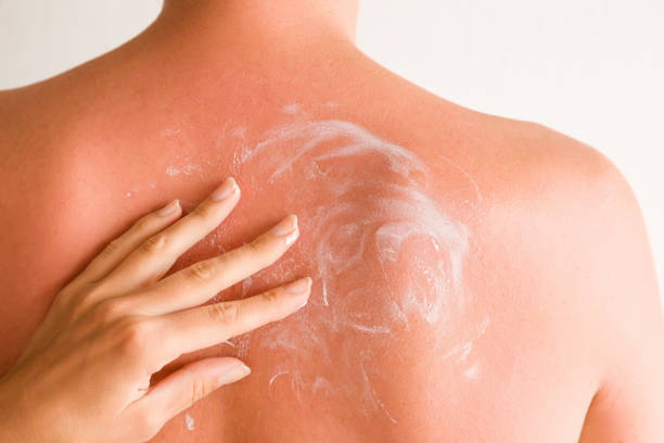 istock On young man's back skin hand smears cream after sun burn. 694315906