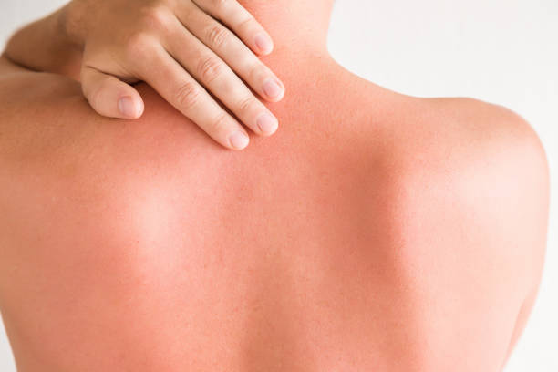 istock Young man's back skin hurt from sun burn. 694315984
