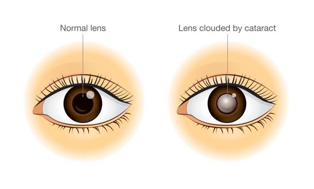 illustrazioni stock, clip art, cartoni animati e icone di tendenza di occhi e lenti normali offuscati dalla cataratta. - cataratta