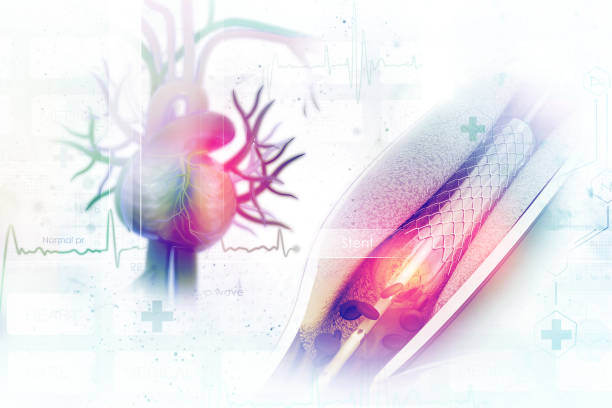 Stent angioplasty procedure with placing a balloon stock photo