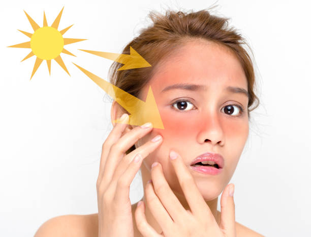 young female with a bad sunburn on her face young female with a bad sunburn on her face skin diagram photos stock pictures, royalty-free photos & images