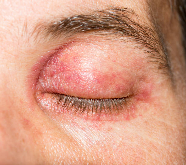 istock Allergic skin irritation inflammation rash around the eye 694518560