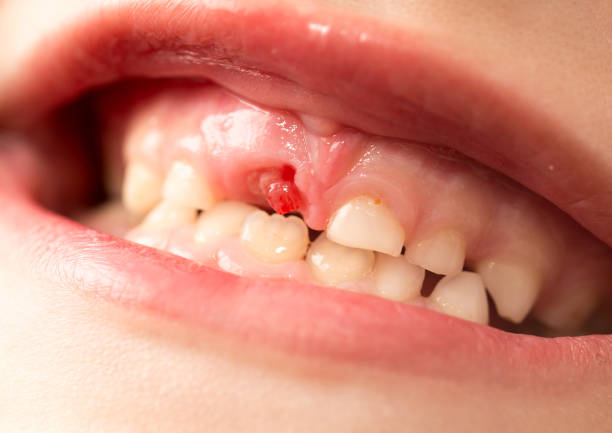 istock The mouth of a boy without a tooth 694526646