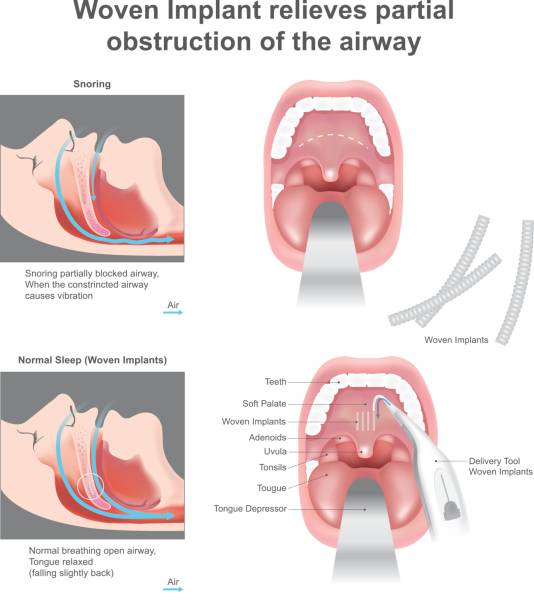 Woven Implant relieves partial obstruction of the airway. The woven implant add structural support and stiffen the soft palate, which reduces the vibration that produces snoring and keeps the palatal tissue from collapsing and obstructing the airway during sleep. Education info graphic. Vector design. relieves stock illustrations