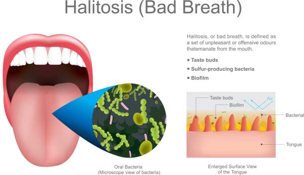 Halitosis (bad breath). Education info graphic. Vector design. Halitosis, or bad breath, is defined as a set of unpleasant or offensive odors taste-bud stock illustrations