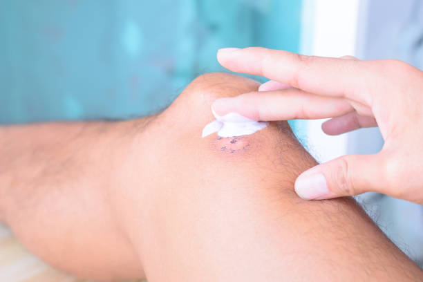istock Treatment for scar on leg. 694969496