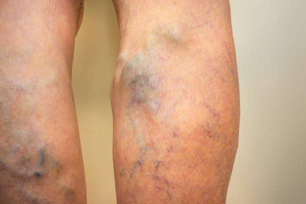 Varicose veins on a leg Varicose veins on a female senior leg close up blood clot photos stock pictures, royalty-free photos & images