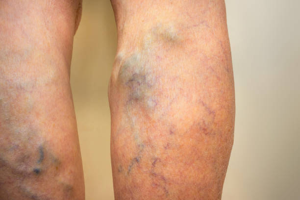 varicose veins on a leg - coágulo imagens e fotografias de stock