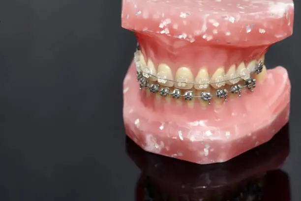 Human jaw or teeth model with metal wired dental braces and closeup